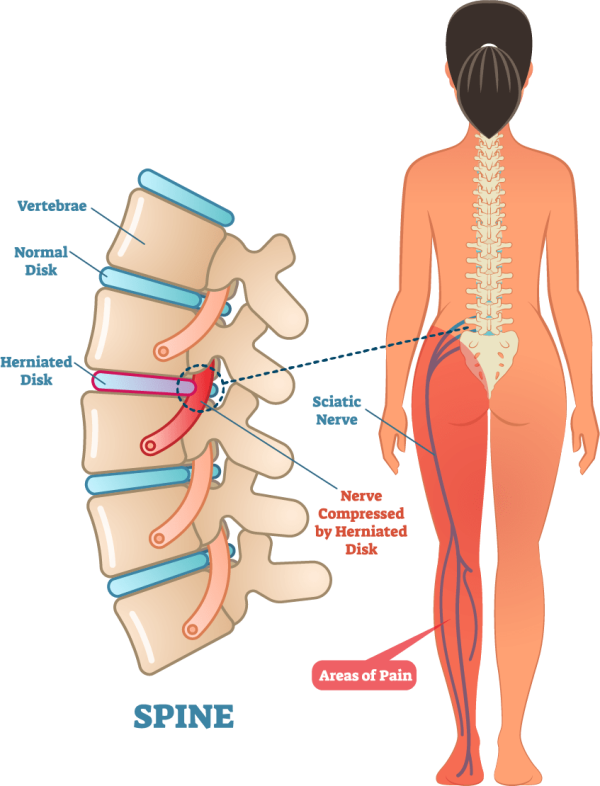 Get Slip Disc Treatment In Pimpri Chinchwad